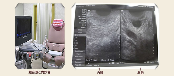 経腟超音波検査