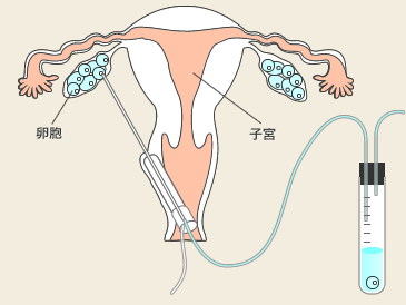 採卵法、麻酔法